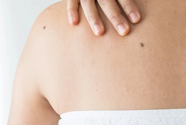 Who is Cryotherapy For_