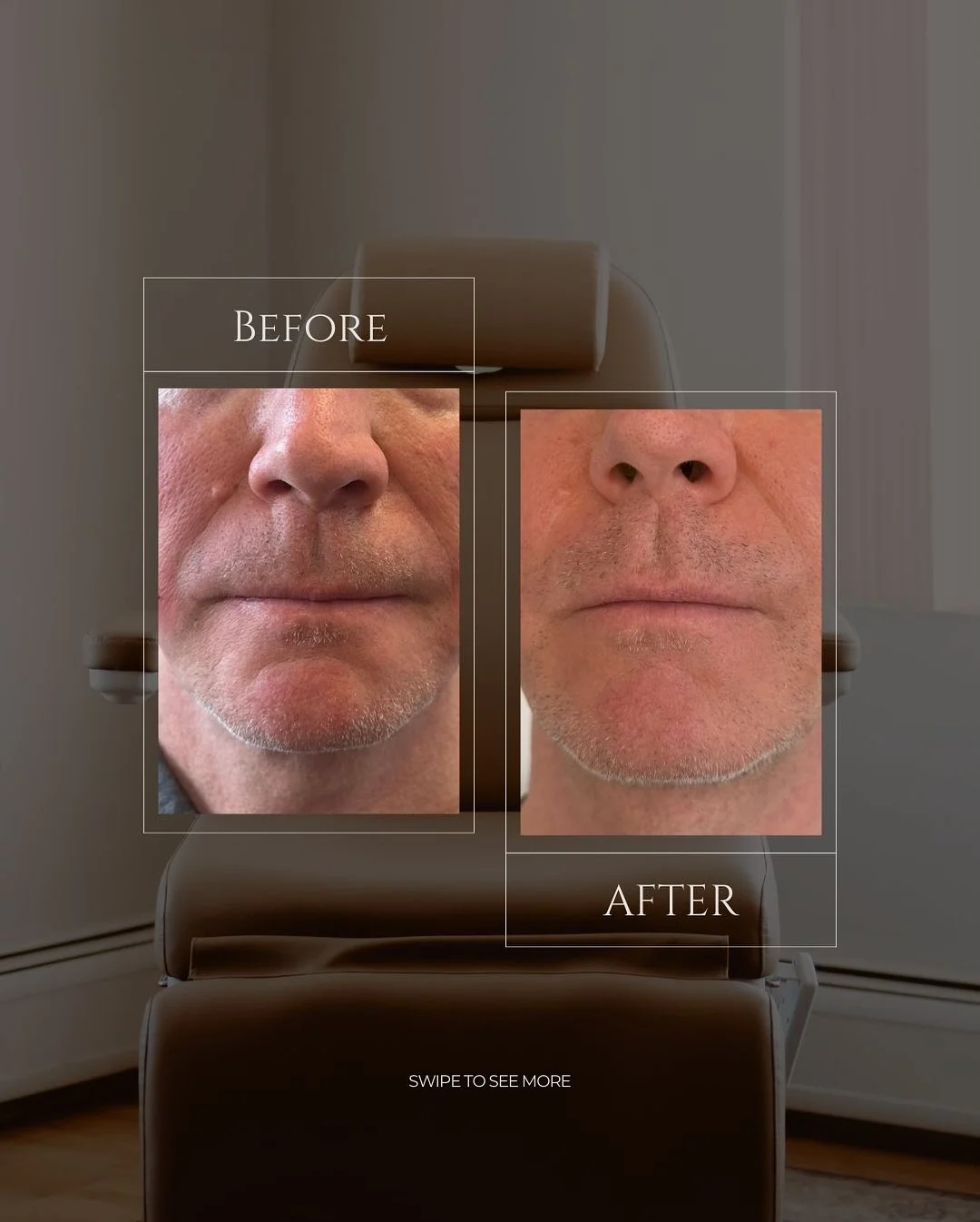 JLUXE BEFORE & AFTER (Dermal Filler - lower face correction)