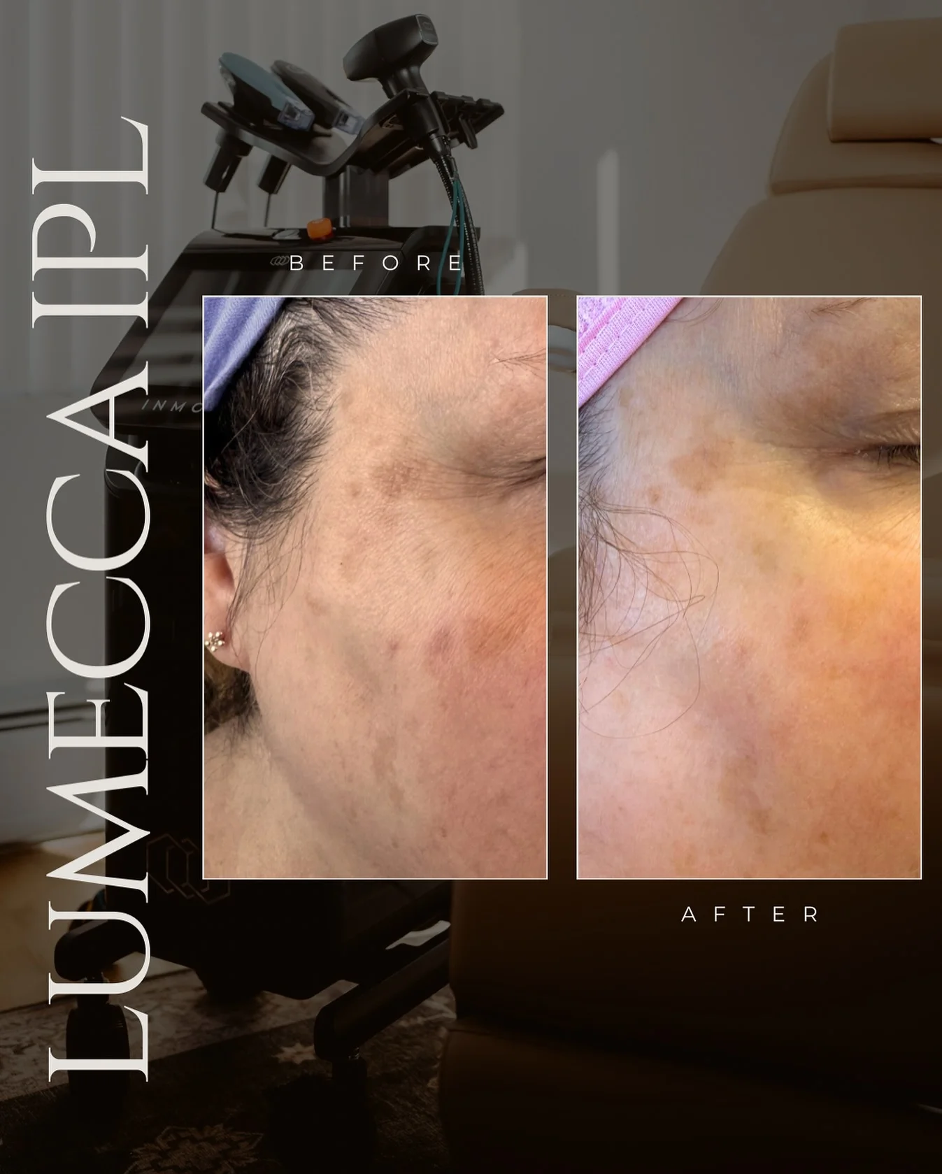 JLUXE BEFORE & AFTER (Lumecca IPL Laser - face)