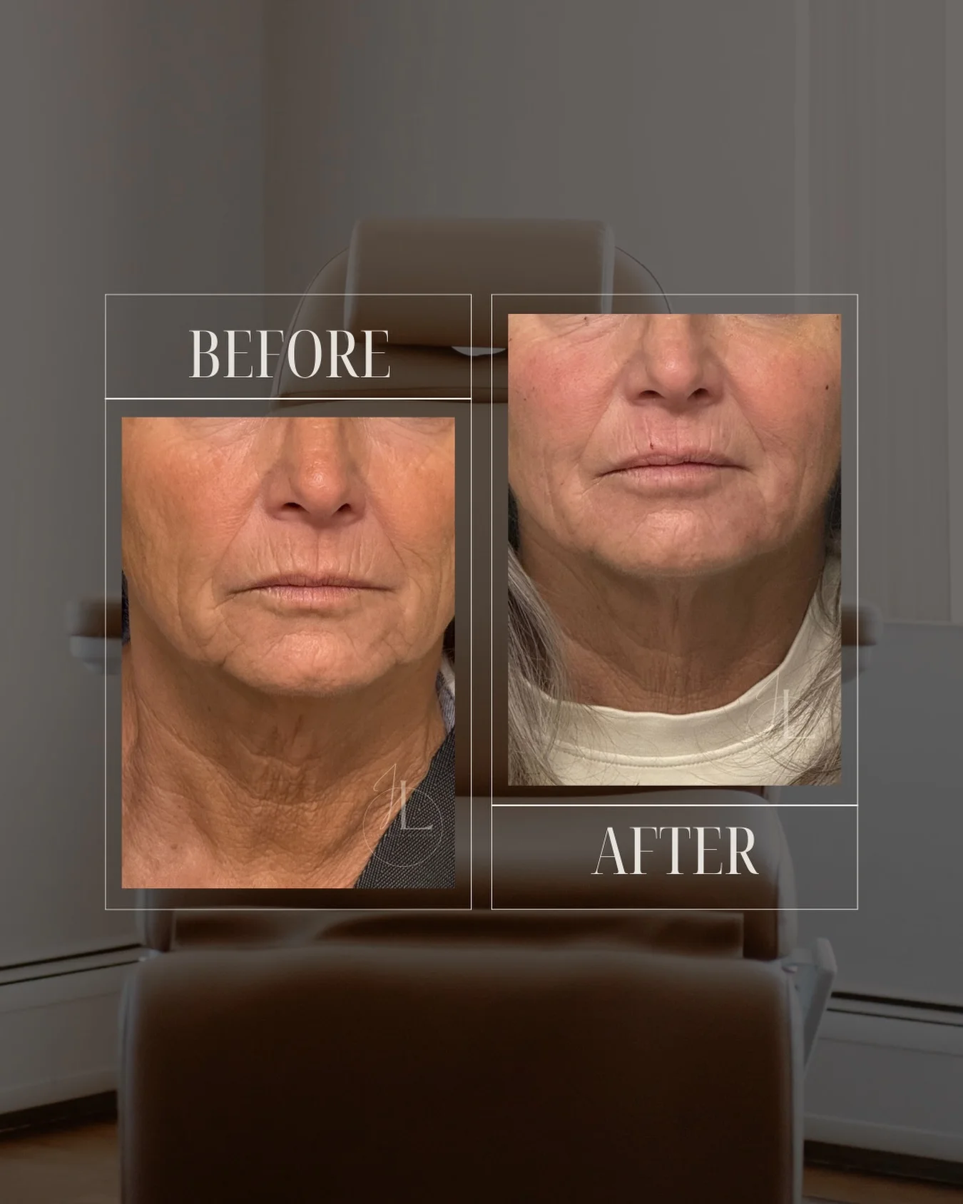JLUXE BEFORE & AFTER (MORPHEUS - face & neck)
