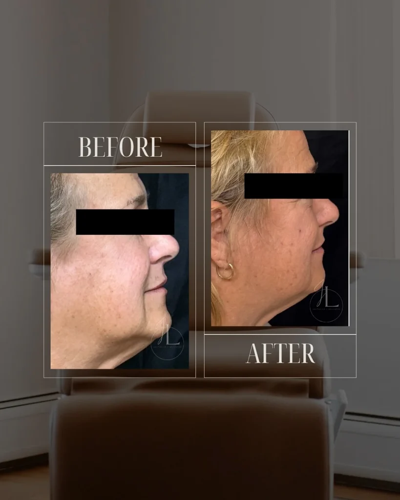 JLUXE BEFORE & AFTER (MORPHEUS face & neck 1)