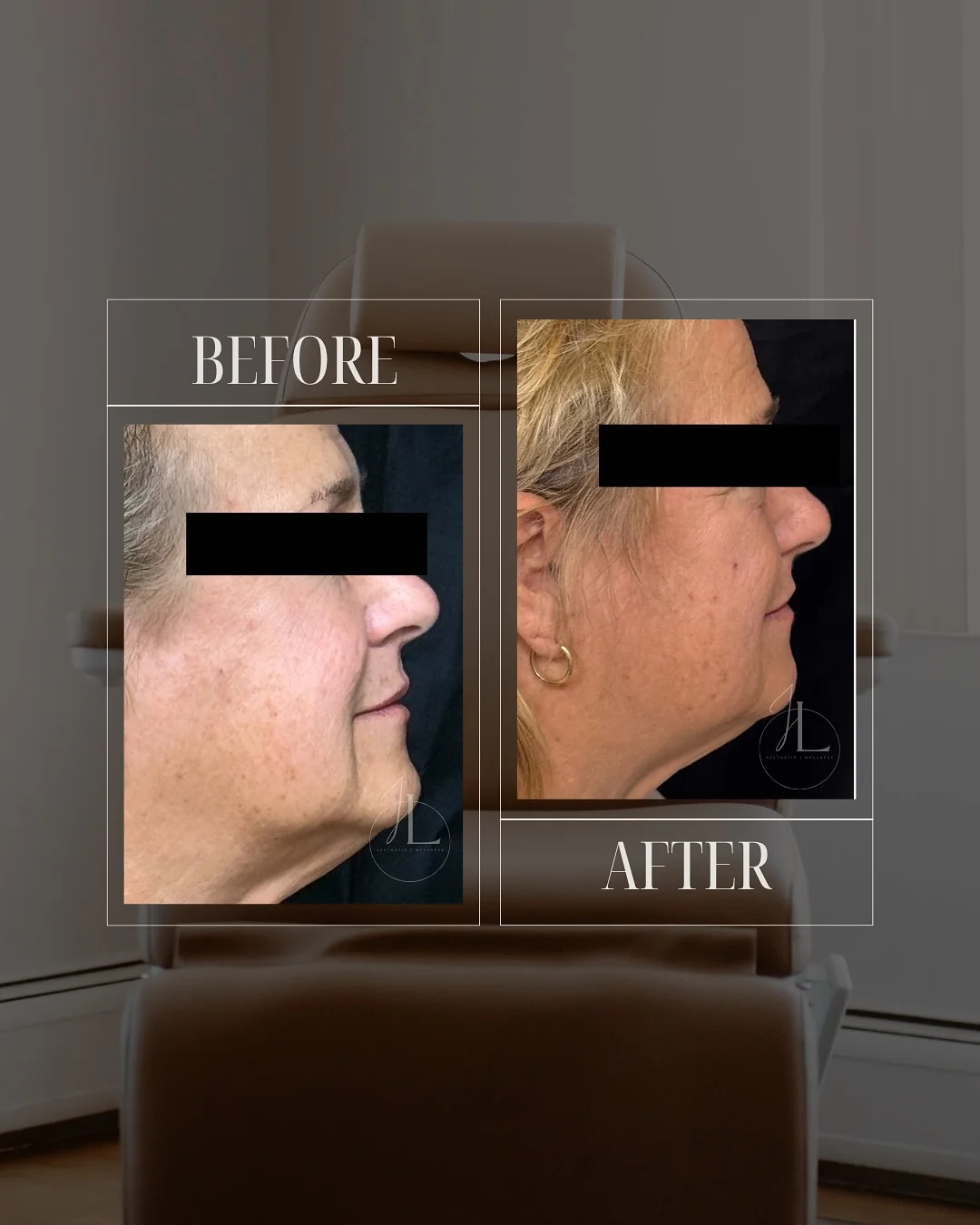 JLUXE BEFORE & AFTER (MORPHEUS face & neck 1)