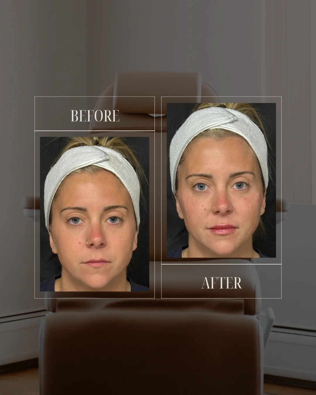 JLUXE BEFORE AND AFTER TEMPLATE (Dermal Filler - Facial rebalancing 3a)