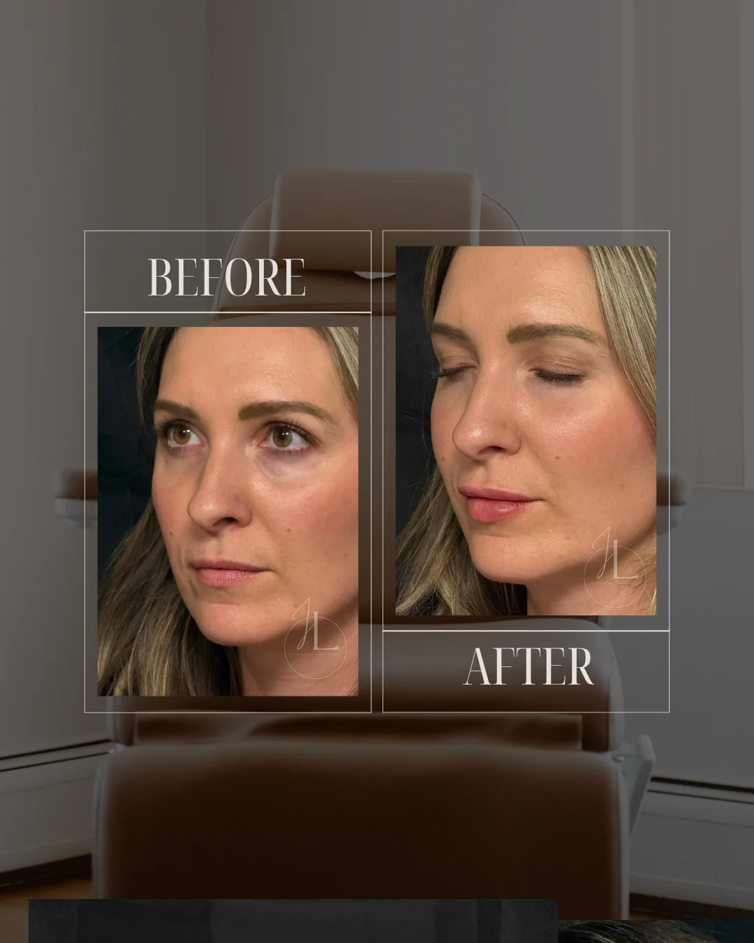 JLUXE BEFORE AND AFTER TEMPLATE (Dermal Filler Lips 1)