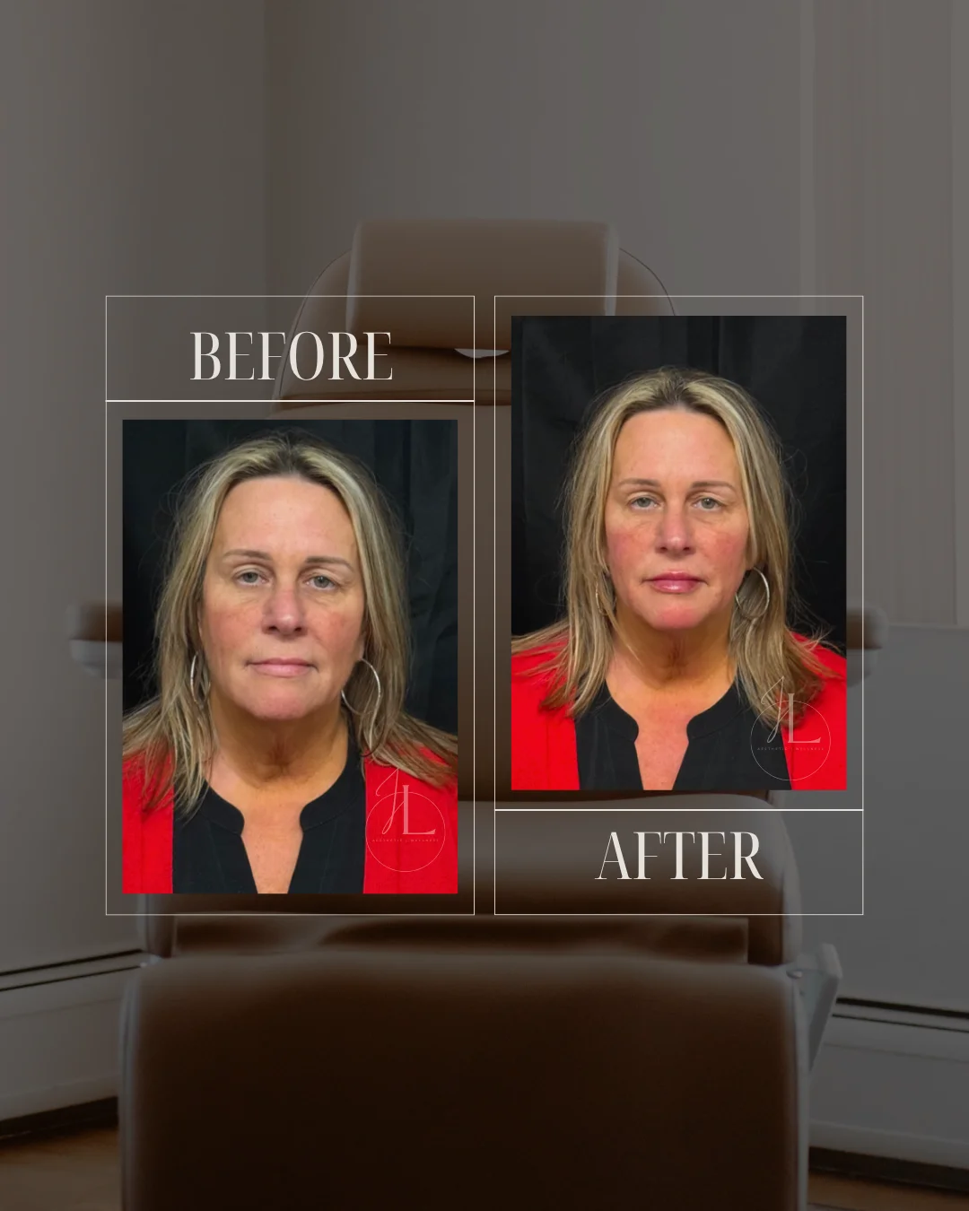 JLUXE BEFORE AND AFTER TEMPLATE (Dermal Filler - Mid & Lower Face)