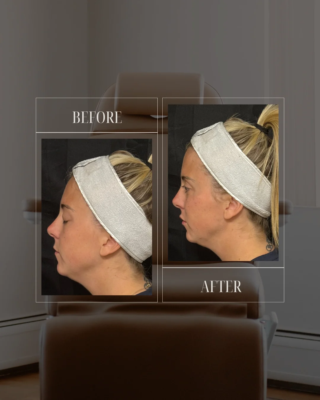 JLUXE BEFORE AND AFTER TEMPLATE (Dermal Filler - facial rebalancing 2a)