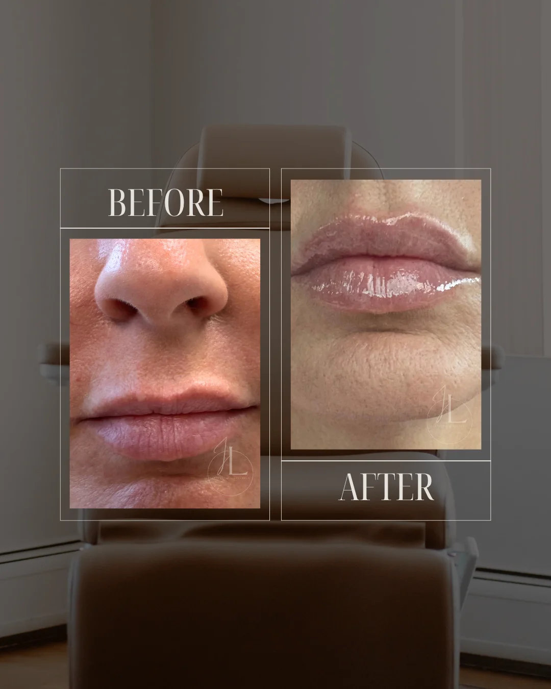 JLUXE BEFORE AND AFTER TEMPLATE (Dermal Filler - lips)