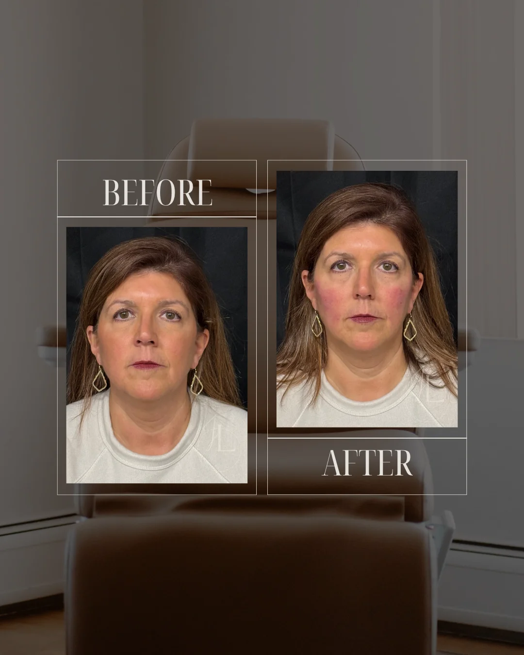 JLUXE BEFORE AND AFTER TEMPLATE (Dermal Filler - mid face)