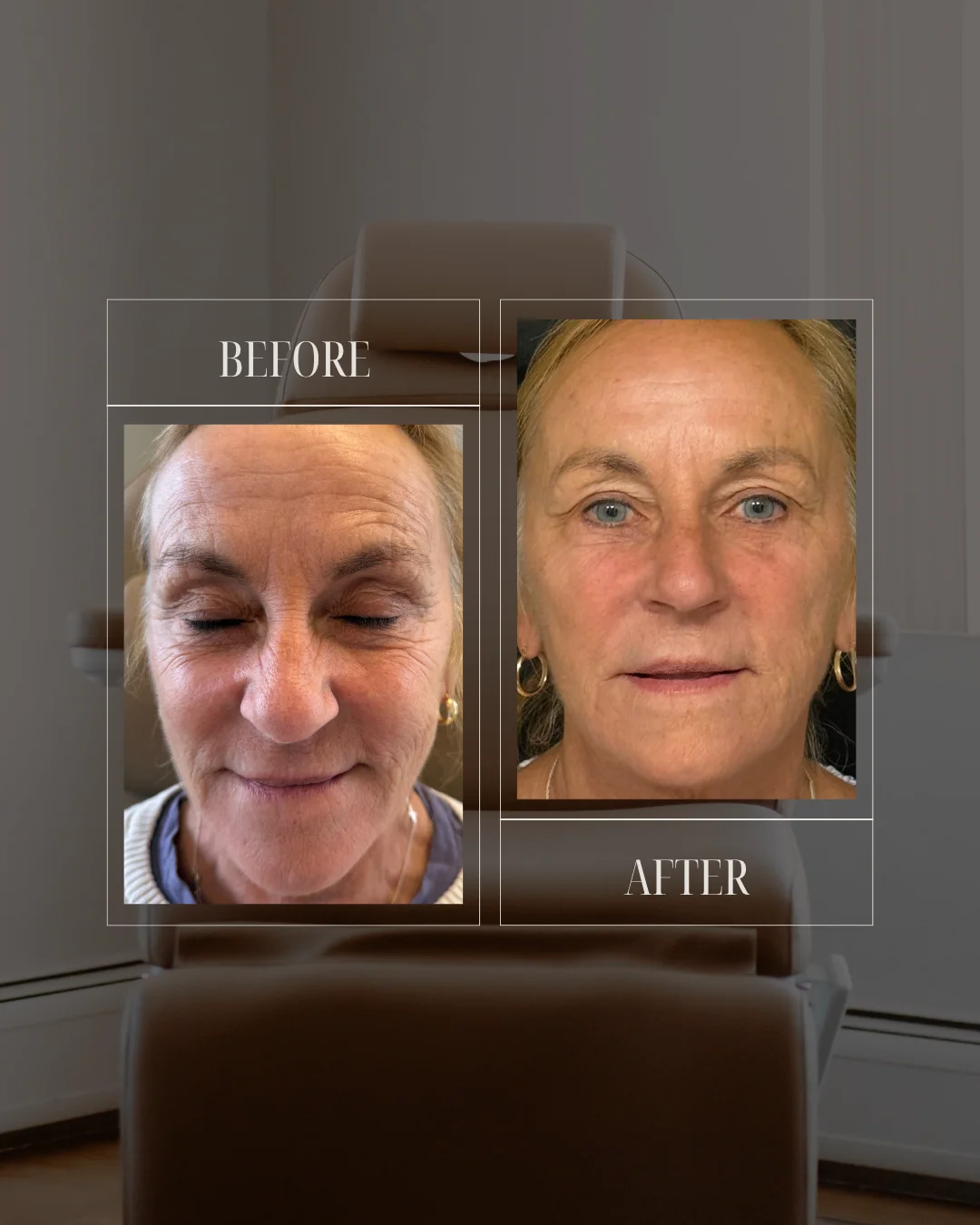 JLUXE BEFORE AND AFTER TEMPLATE (MORPHEUS - face)