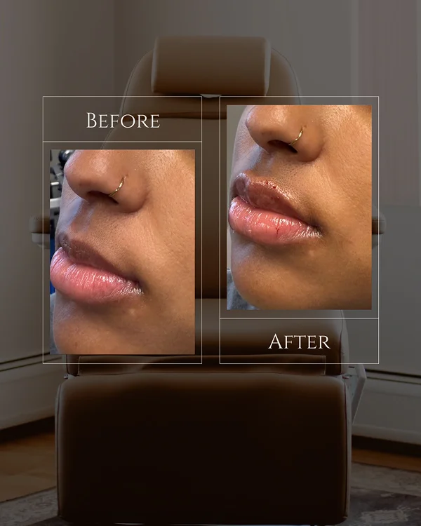 Lip Filler 2-1