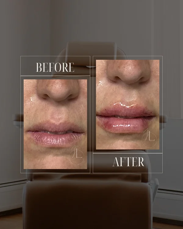 Lip Filler 2