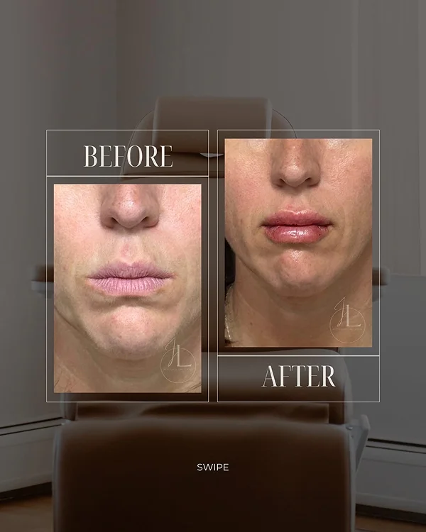 Lip Filler(1) 1-1