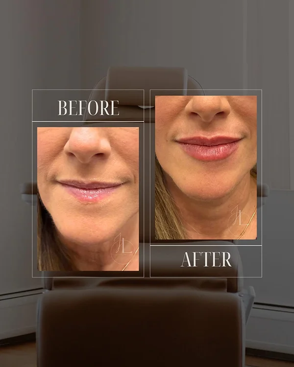 Lip Filler(1) 1