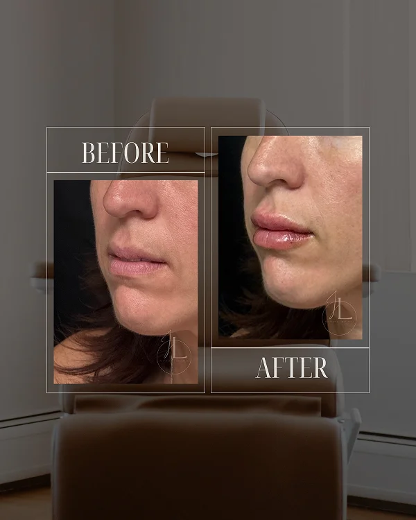 Lip Filler(1) 2