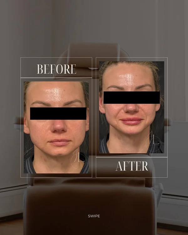 Lip Filler(2) 1-1