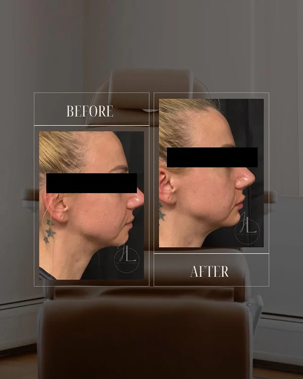 Lip Filler(3) 1-1