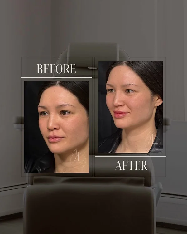 Lip Filler(3) 1