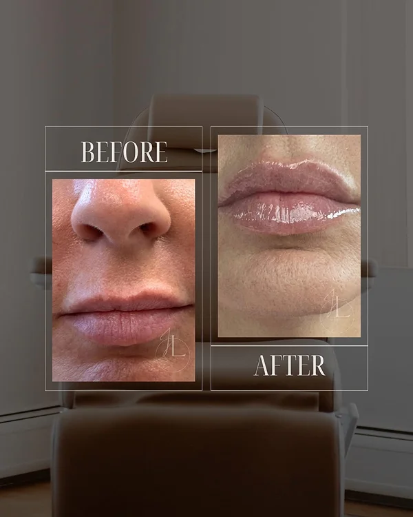 Lip Filler(4) 1-1