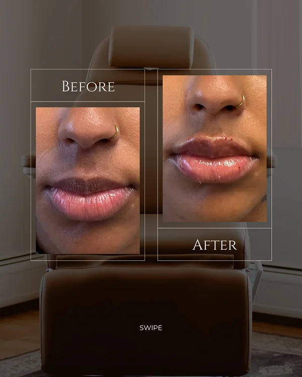 Lip Filler(4) 2