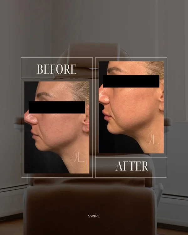 Lip Filler(5) 1-1