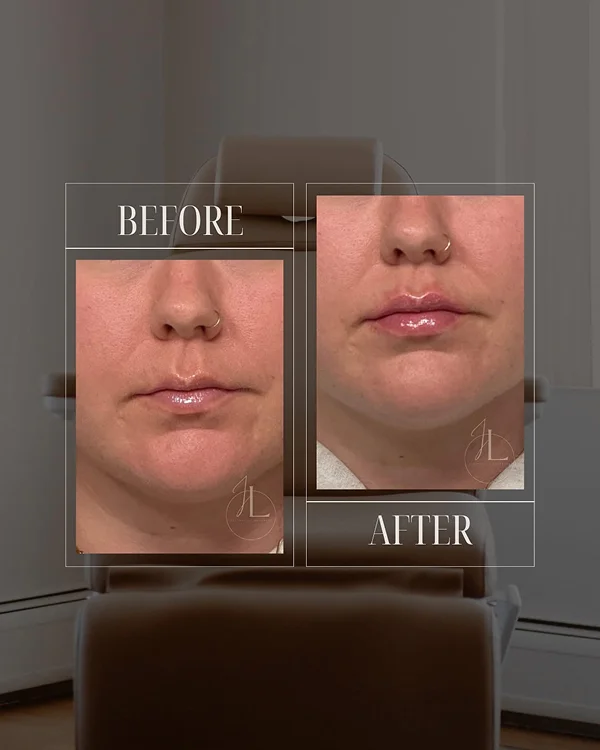 Lip Filler(5) 1