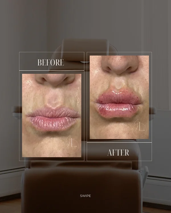 Lip Filler(5) 2