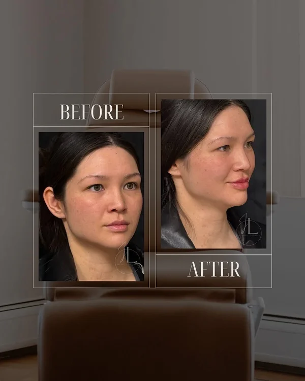 Lip Filler(6) 1