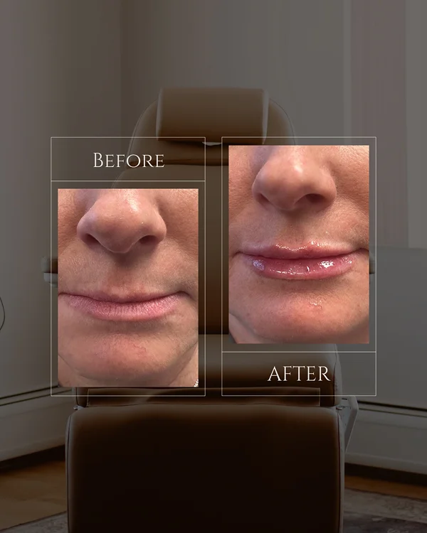 Lip Filler(7) 1-1