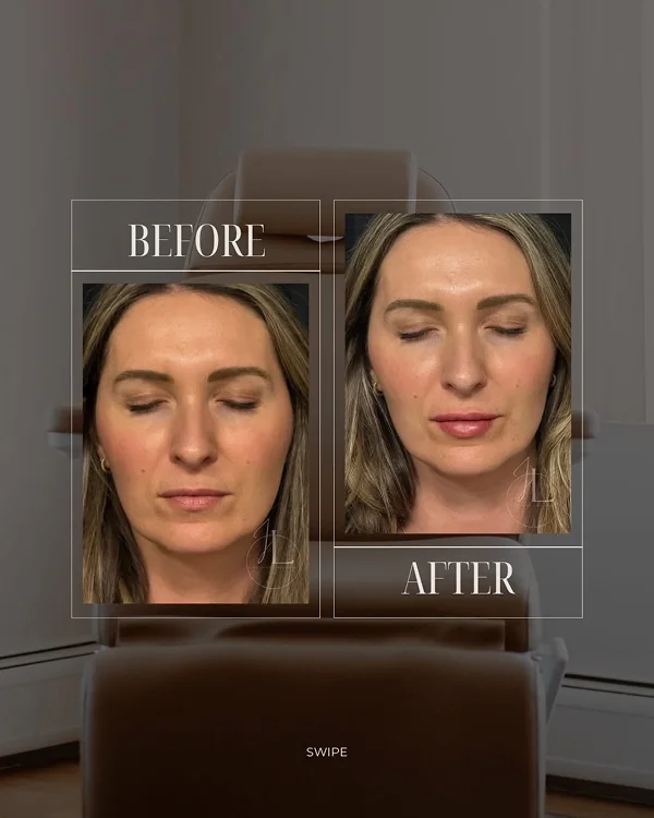 Lip Filler_(1) 1