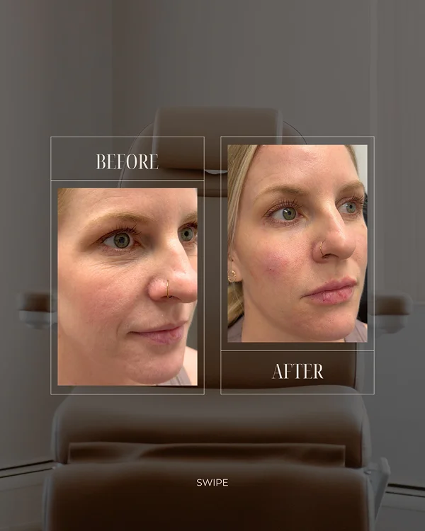 Lower Face & Lip Filler 1