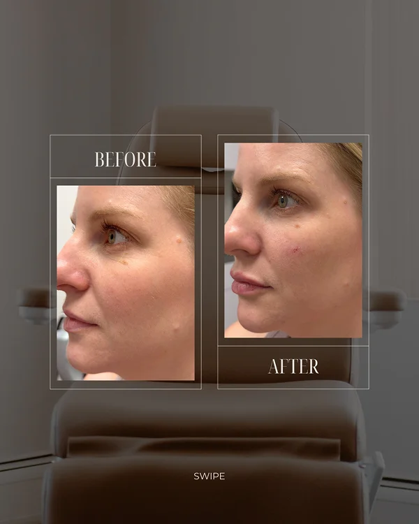 Lower Face & Lip Filler(1) 1