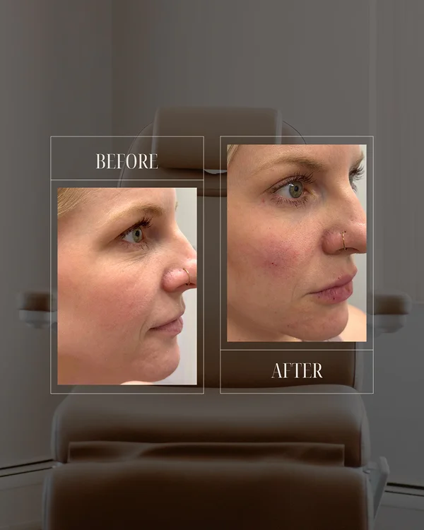 Lower Face & Lip Filler(2) 1