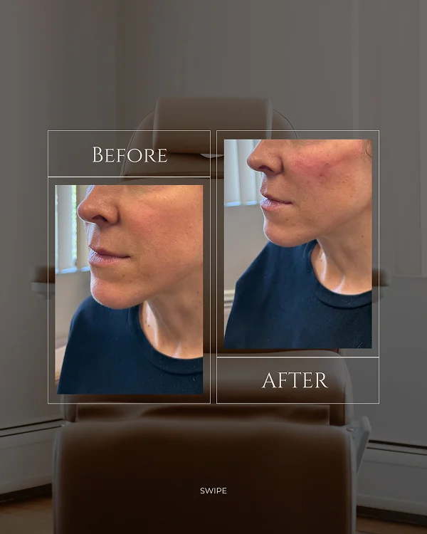 Mid Face Filler 1