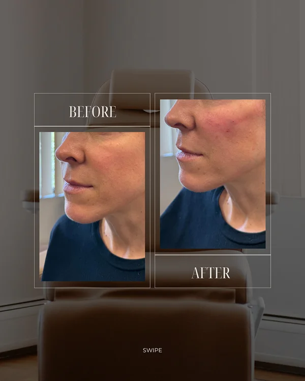 Mid Face Filler(1) 1