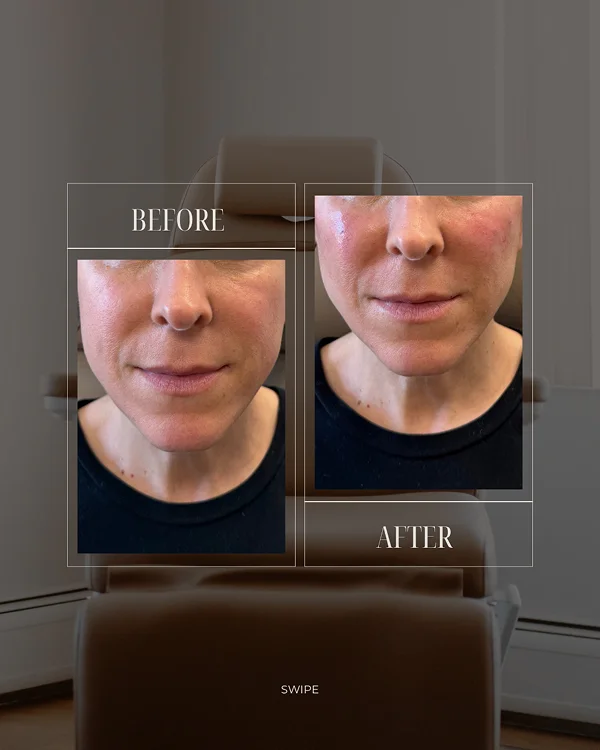 Mid Face Filler_ 1
