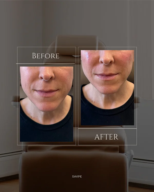 Mid Face Filler_(1) 1