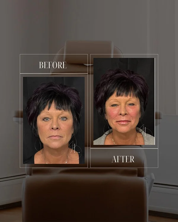 Mid Face & Jawline Filler 1