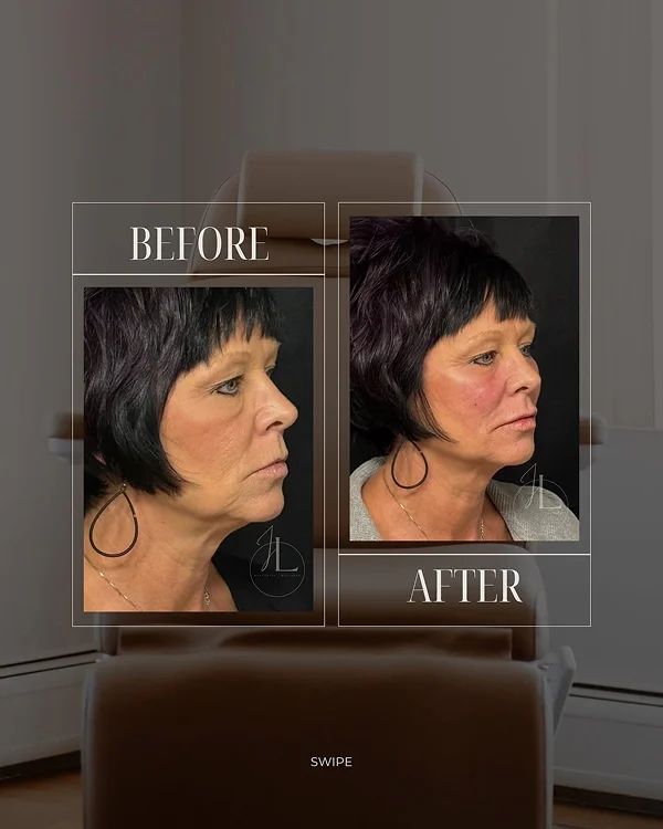 Mid Face & Jawline Filler(2) 1