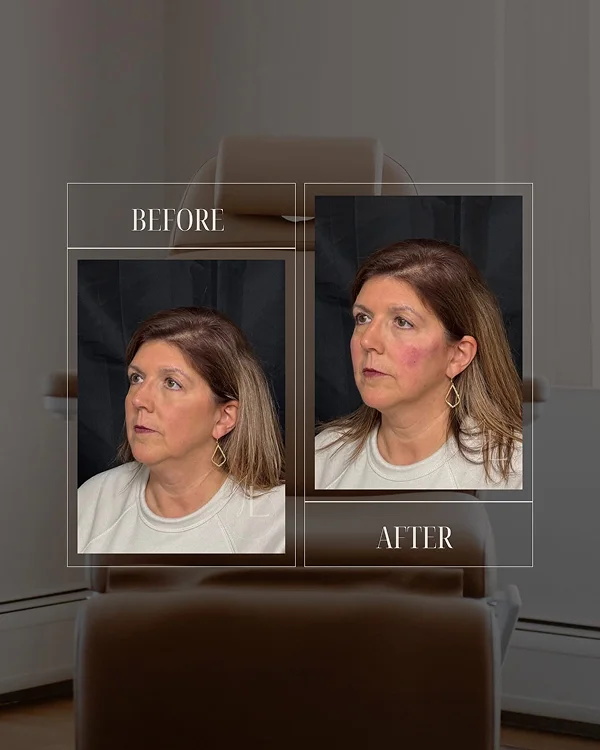 Mid Face & Jawline Filler(3) 1