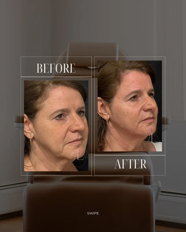 Mid Face & Jawline Filler(3) 2