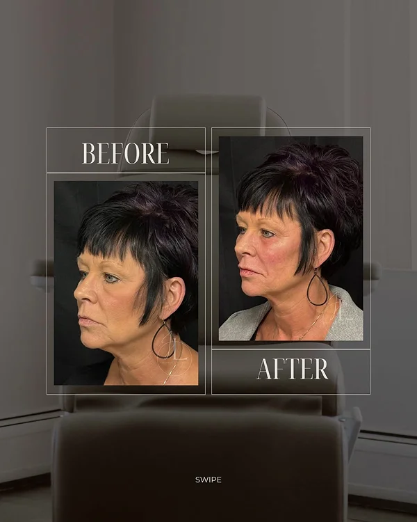 Mid Face & Jawline Filler(4) 1
