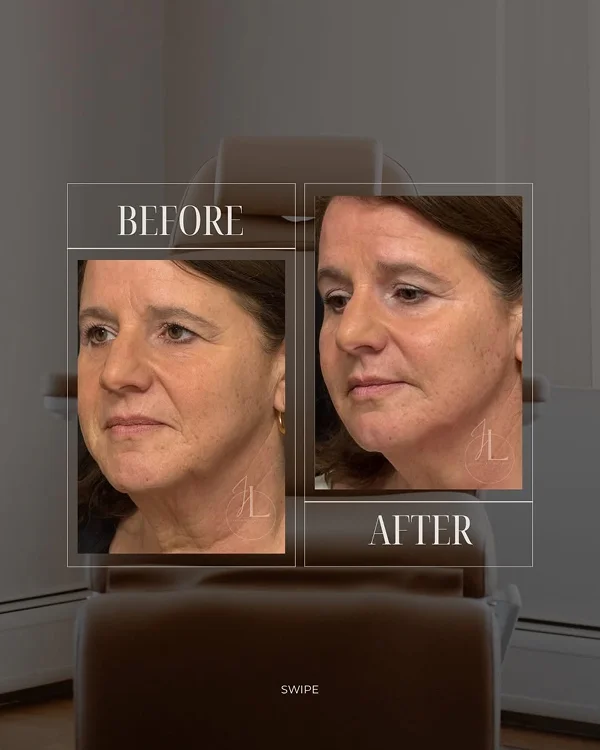 Mid Face & Jawline Filler_ 1