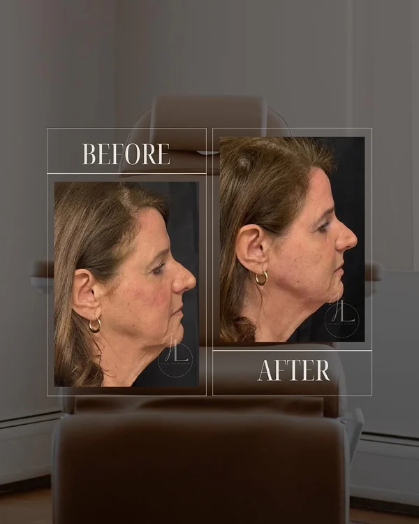 Mid Face & Jawline Filler_(1) 1