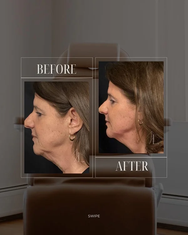 Mid Face & Jawline Filler_(2) 1
