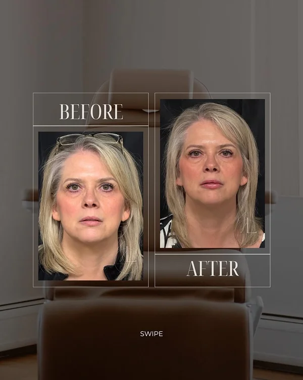 Mid Face & Lip Filler 1