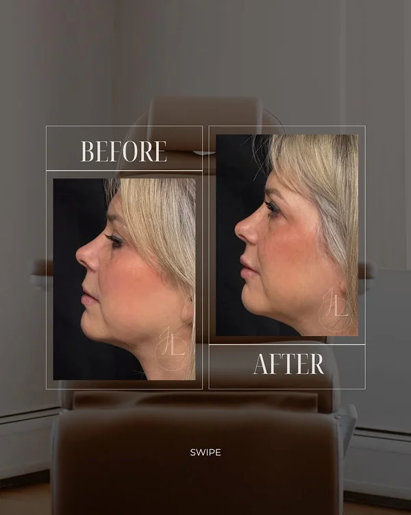 Mid Face & Lip Filler(1) 1