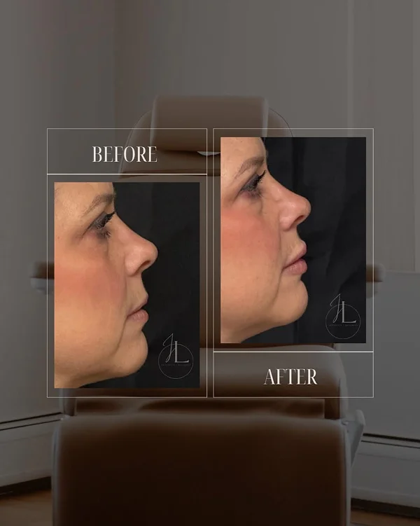 Mid Face & Lip Filler(2) 1