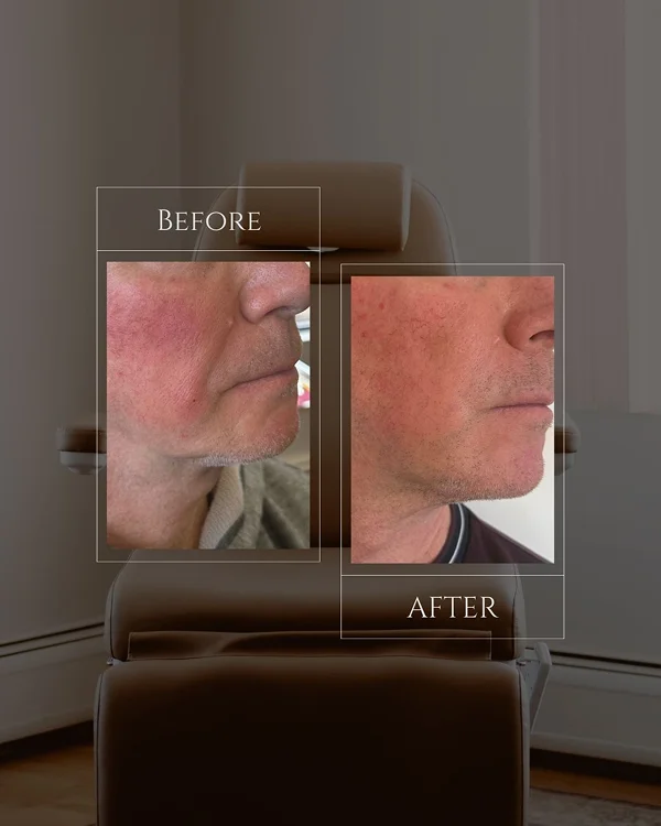 Nasolabial Filler 1