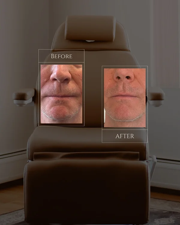 Nasolabial Filler 2