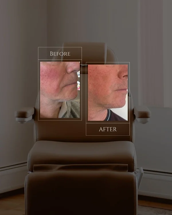 Nasolabial Filler(1) 1